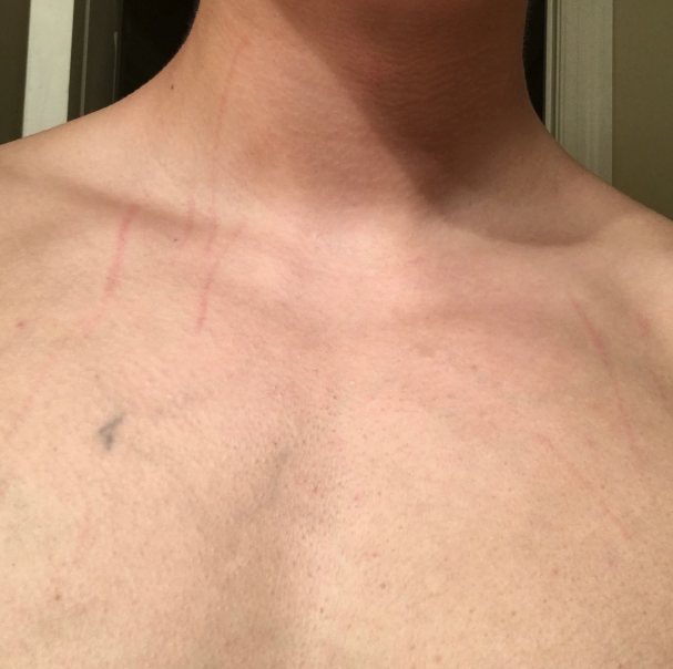 Bartonella tracks on chest